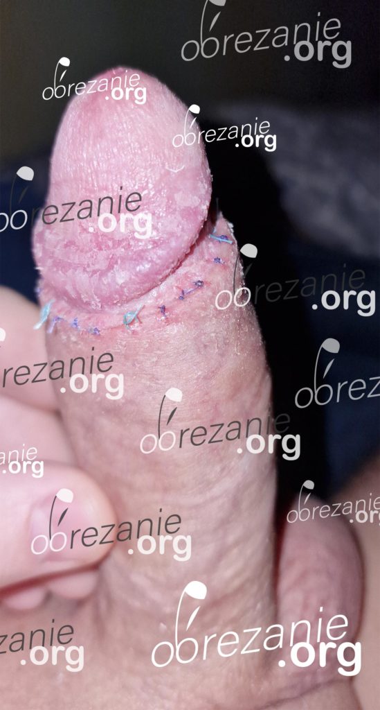 Фото после обрезания с утолщением заживление шва