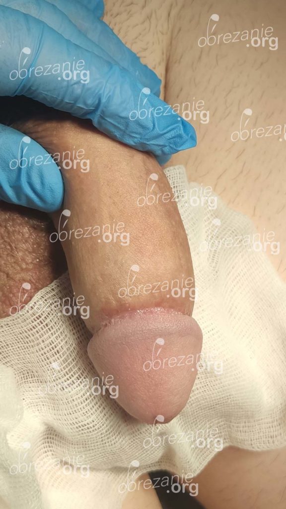Фото обрезания под головку через 1 месяц