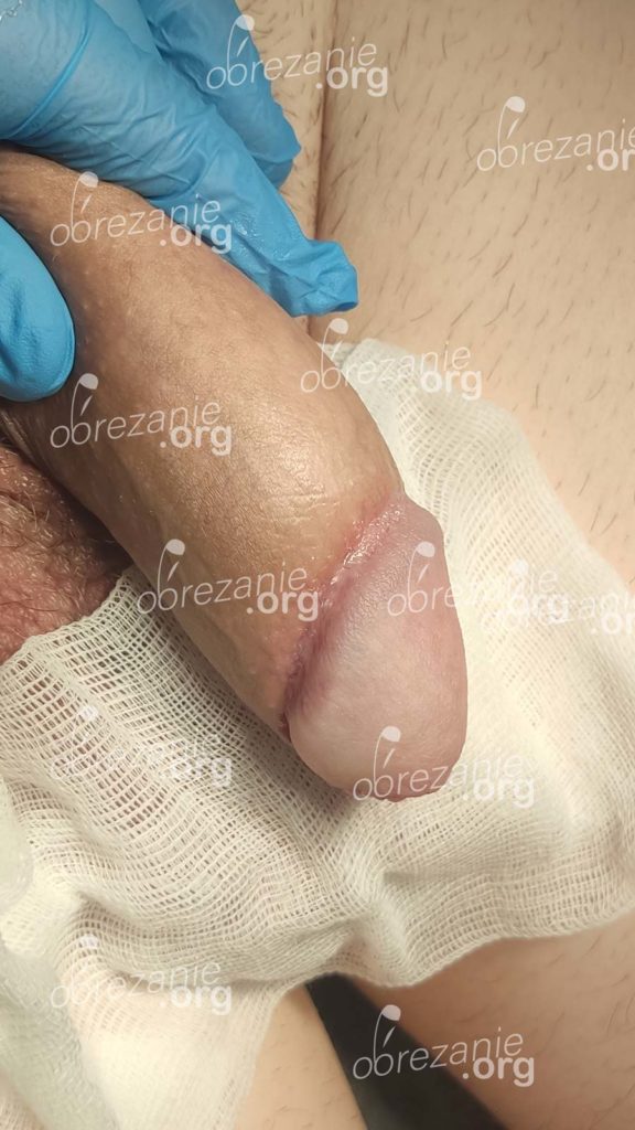 Фото обрезания под головку через 1 месяц