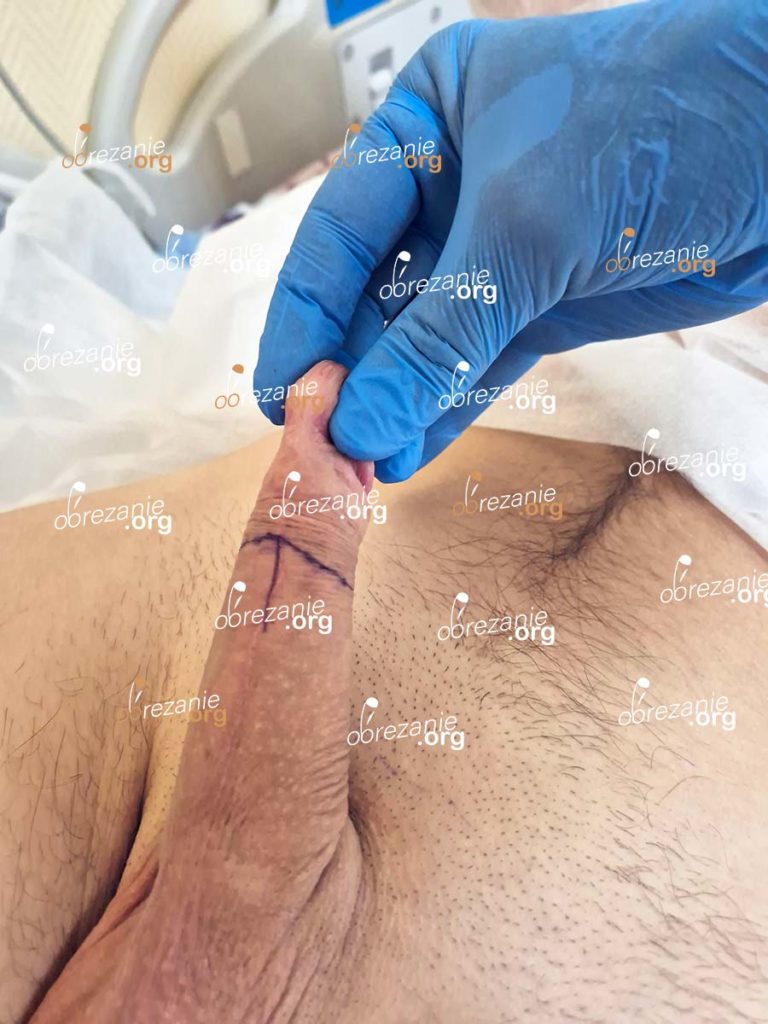 До обрезания