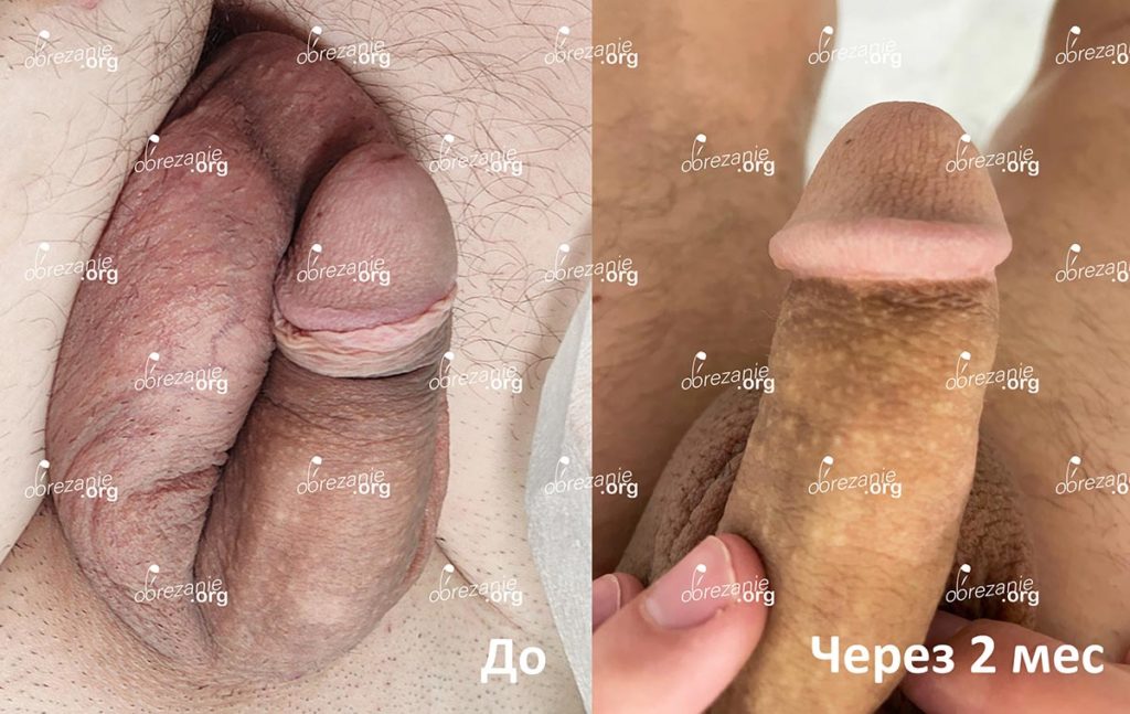 Через 2 месяца после обрезания под головку